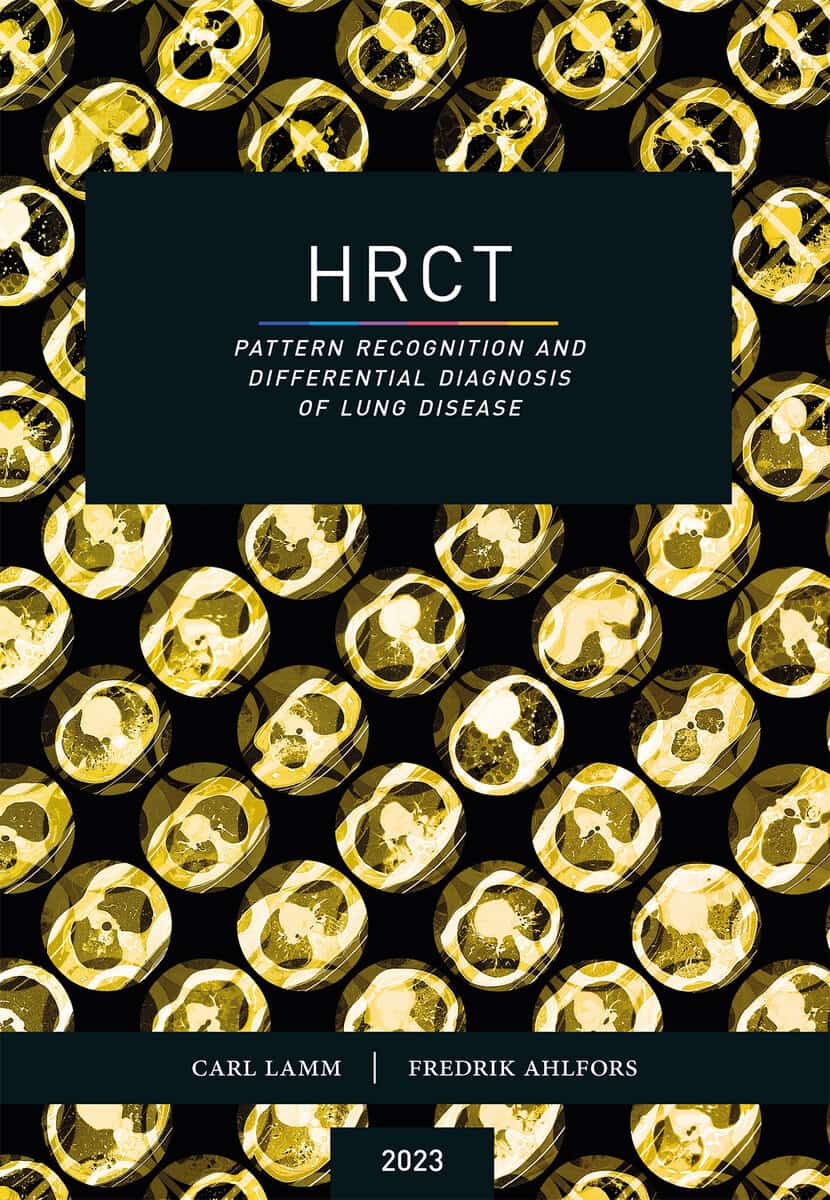 Lamm, Carl | Ahlfors, Fredrik | HRCT : Pattern recognition and differential diagnosis of lung disease