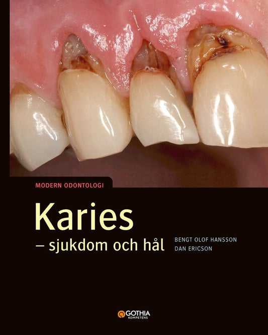 Hansson, Bengt Olof | Ericson, Dan | Karies : Sjukdom och hål