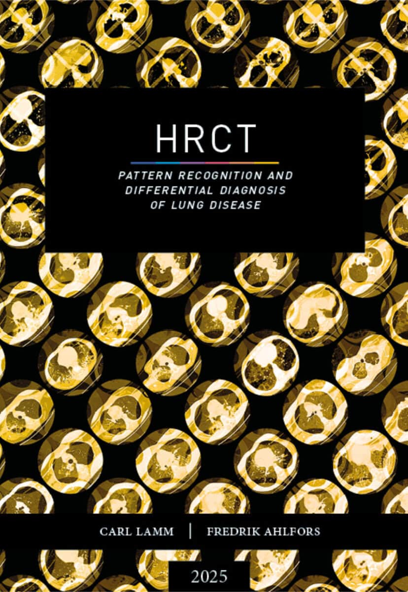 Lamm, Carl | Ahlfors, Fredrik | HRCT : Pattern recognition and differential diagnosis of lung disease
