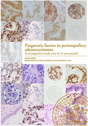 Elebro, Jacob | Prognostic factors in periampullary adenocarcinoma
