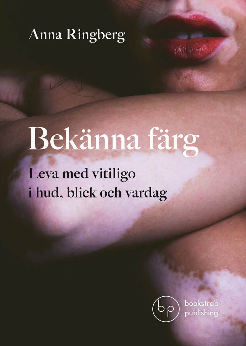 Ringberg, Anna | Bekänna färg : Leva med vitiligo i hud, blick och vardag