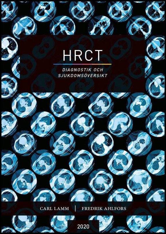 Lamm, Carl| Ahlfors, Fredrik | HRCT : Diagnostik och sjukdomsöversikt