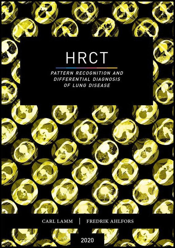 Lamm, Carl| Ahlfors, Fredrik | HRCT : Pattern recognition and differential diagnosis of lung disease